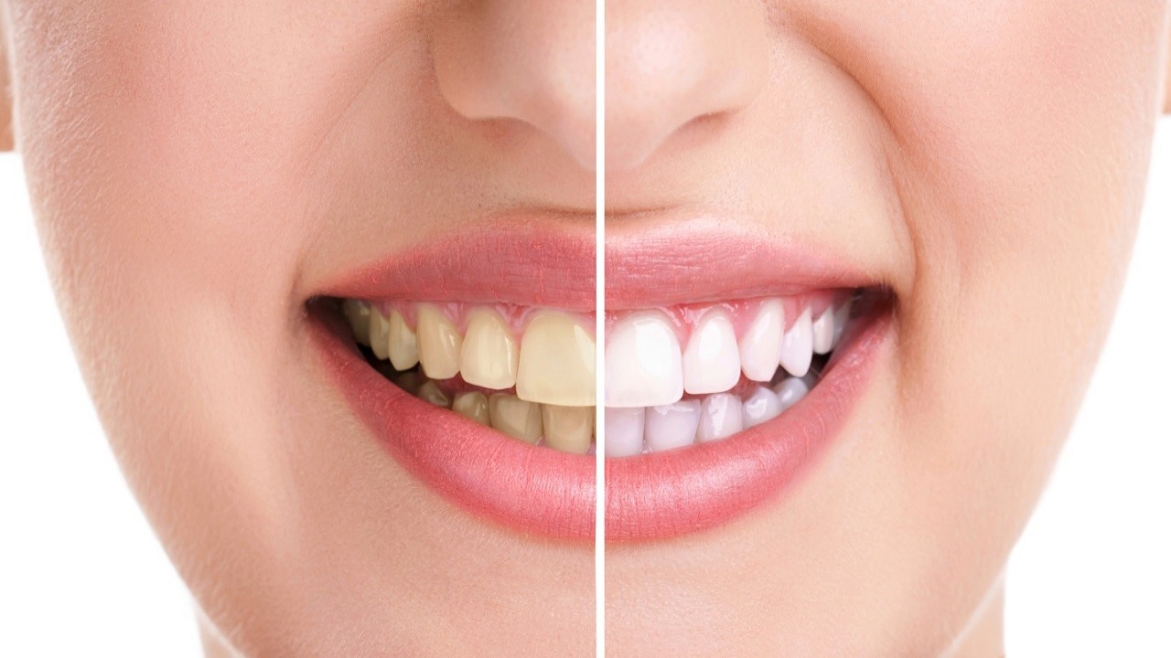 Tình trạng răng miệng cũng ảnh hưởng tới việc đính đá răng